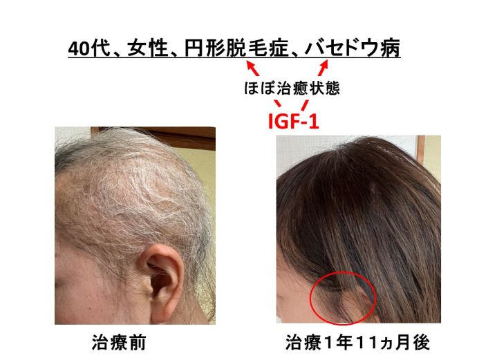 円形脱毛症　病院